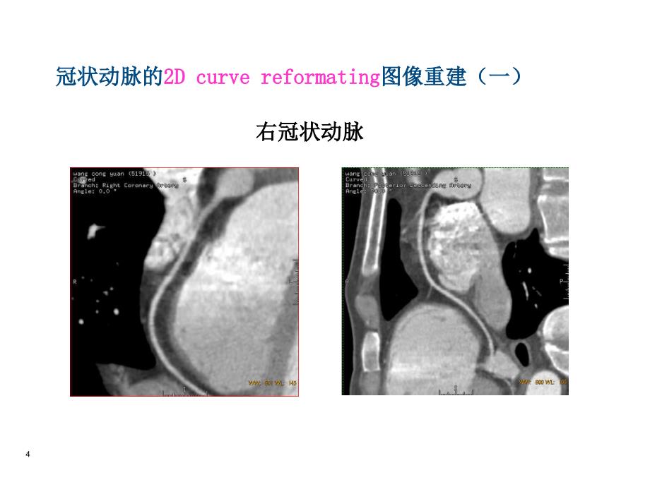 多层CT冠脉成像－医学影像学（上海交通大学医学院）_第4页