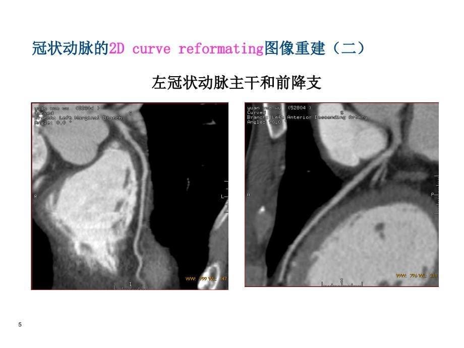 多层CT冠脉成像－医学影像学（上海交通大学医学院）_第5页
