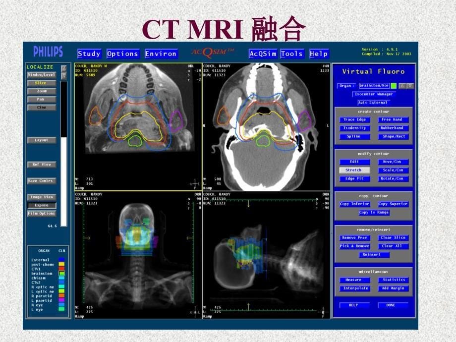 鼻咽癌靶区勾画与剂量处方(胡超苏）_第5页