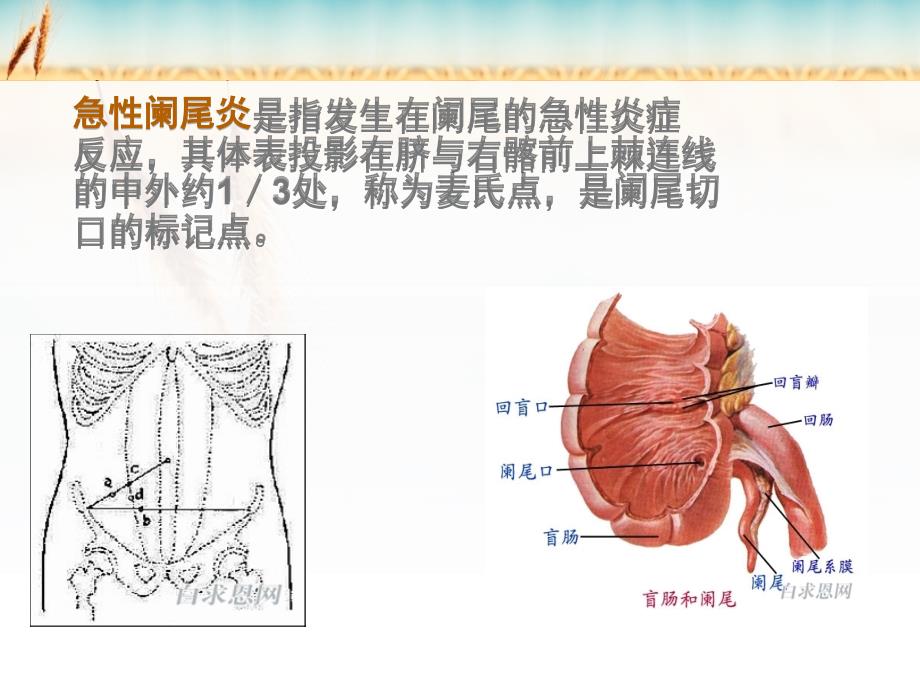 急性阑尾炎的护理_第4页