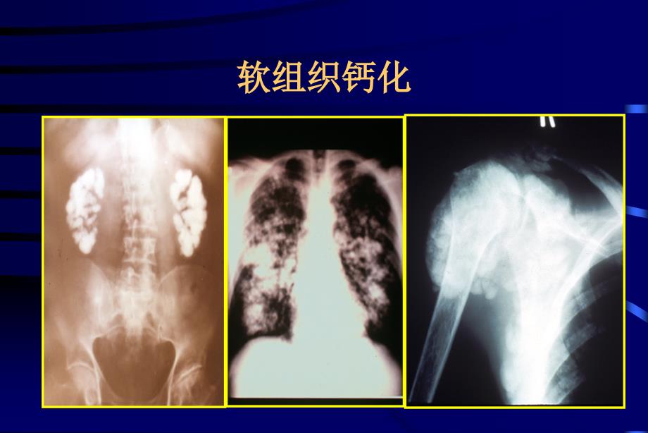 慢性肾脏病时的钙磷代谢异常及骨病_第3页