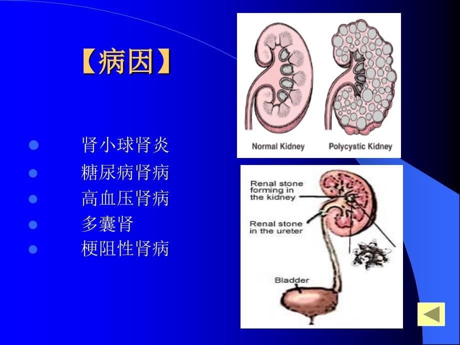 慢性肾功能衰竭新_第5页