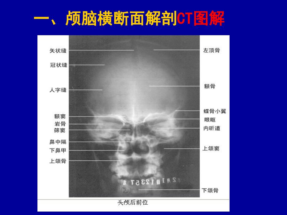 头颈部CT应用 PPT课件_第3页