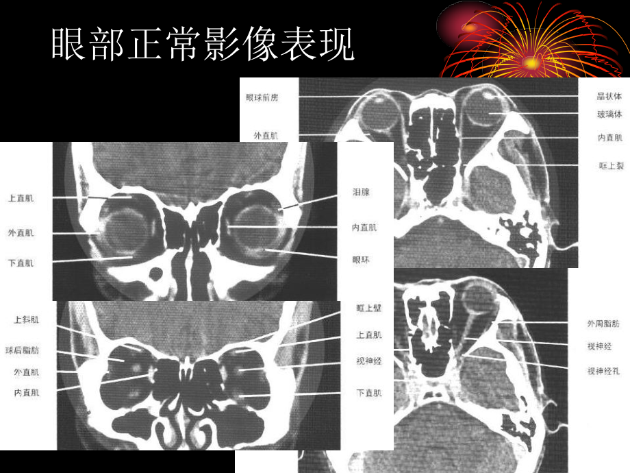 头颈部疾病CT诊断 PPT课件_第3页