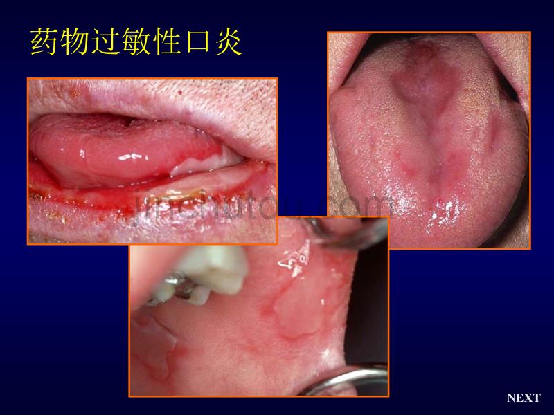 口腔黏膜变态反应_第5页