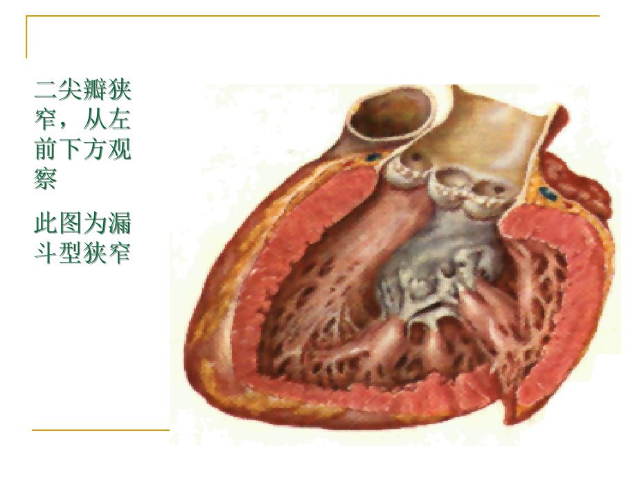 心脏瓣膜病超声诊断_第4页
