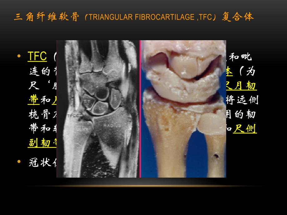 腕关节疾病的MRI诊断和解剖_第2页