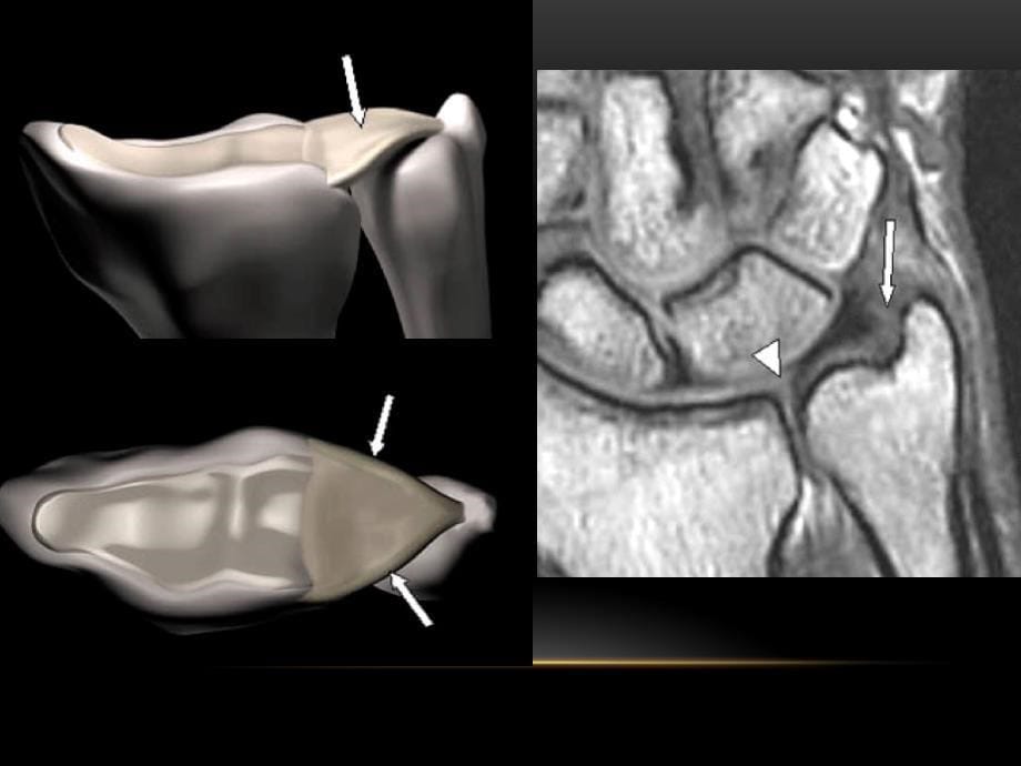 腕关节疾病的MRI诊断和解剖_第5页
