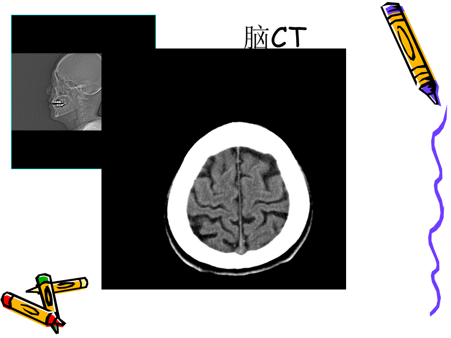 1OK-脑外伤讲解很好颅脑CT诊断2_第2页