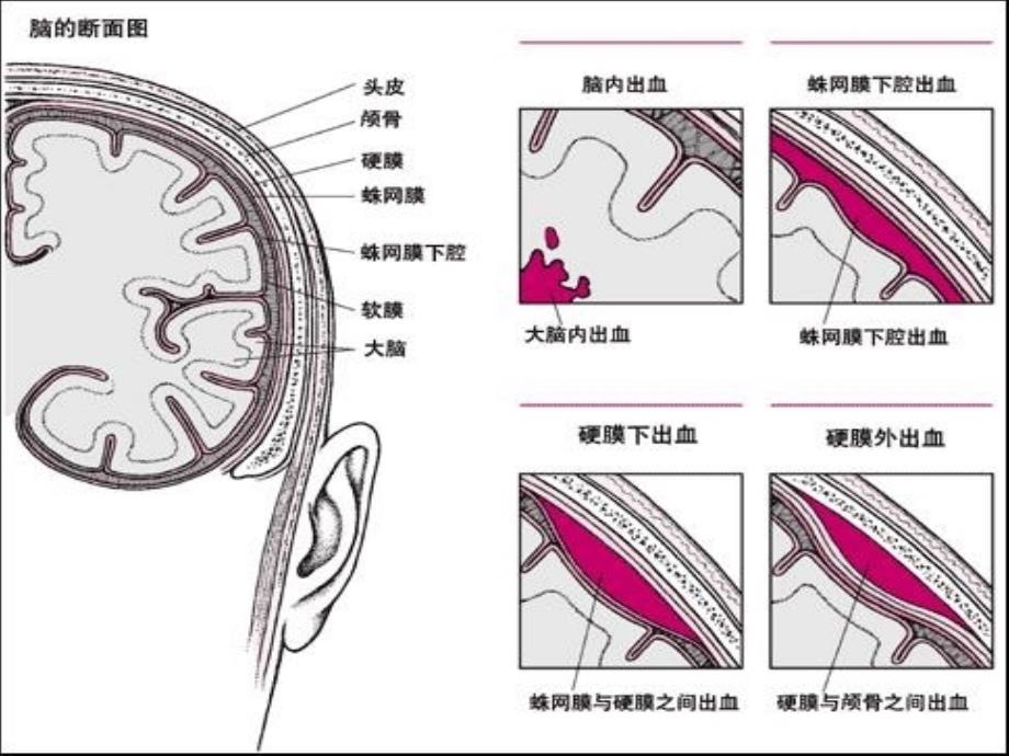 神经外科常见引流管的护理-外科_第2页