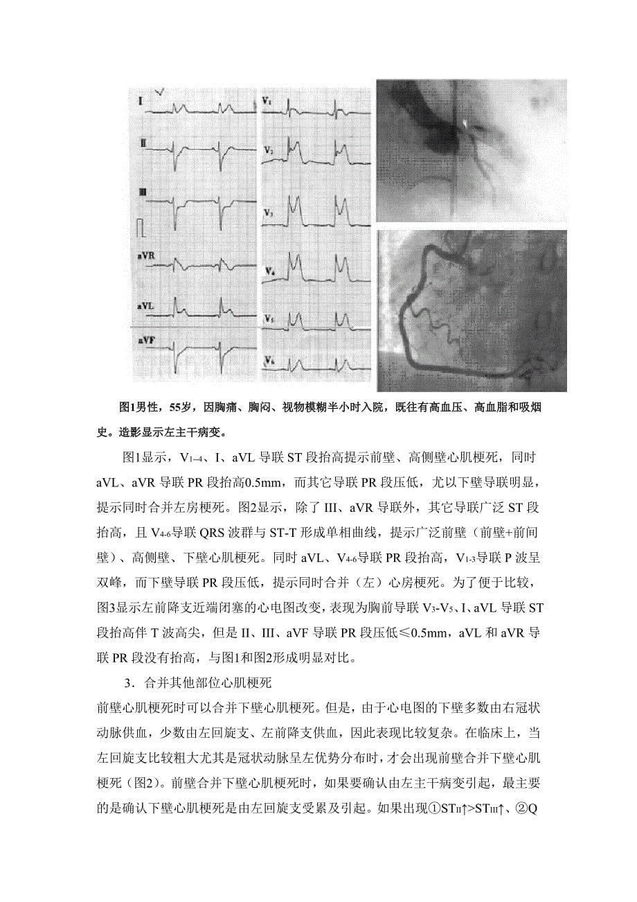 左主干闭塞引起急性心肌梗死的心电图特点_第5页