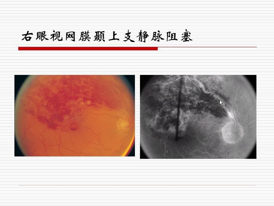 [医疗保健]中医对眼底出血性疾病的研究_第5页