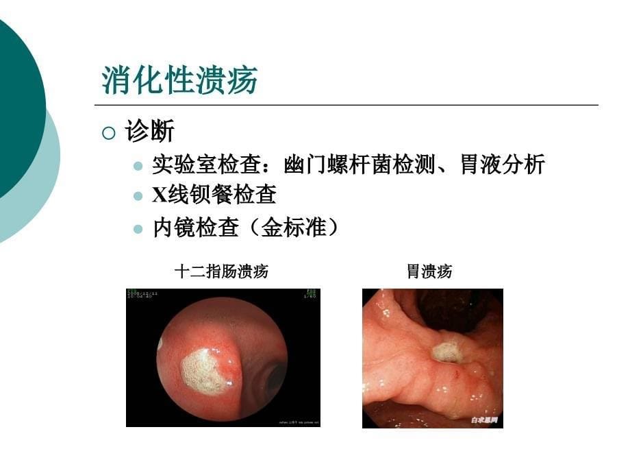 消化系统常见疾病_第5页