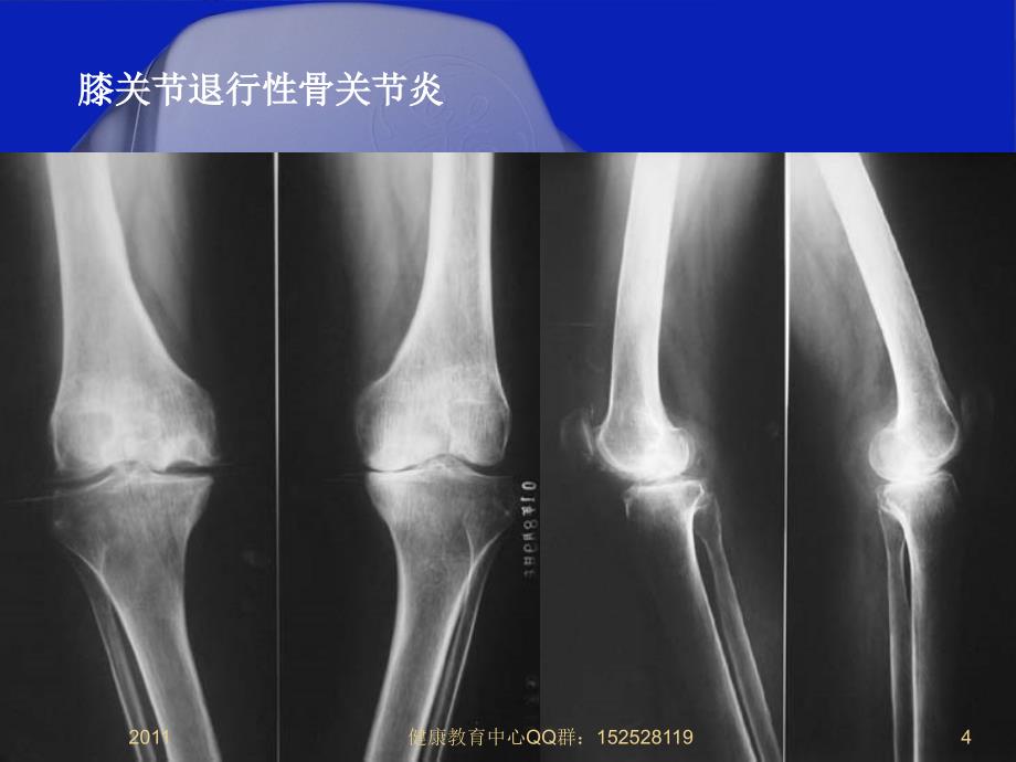 潘良春2《骨关节炎的家庭防治》_第4页