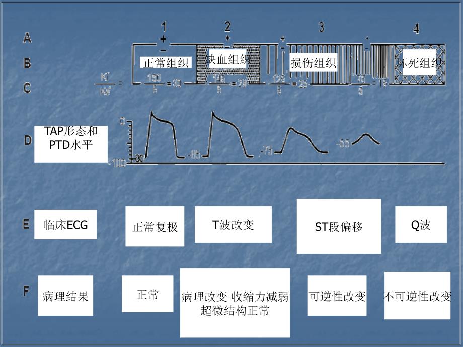 临床缺血ecg新概念_长城心脏病大会_第4页