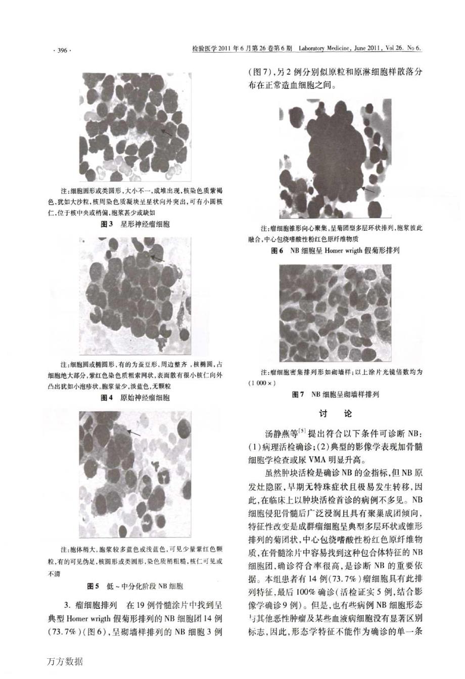 骨髓涂片检查对神经母细胞瘤诊断的意义_第3页