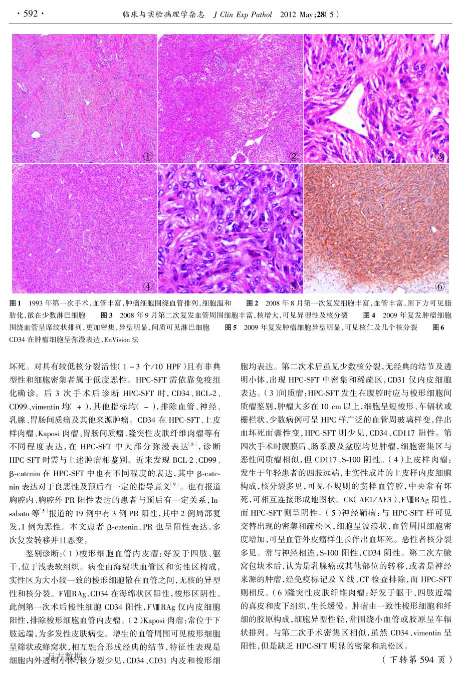 软组织孤立性纤维性肿瘤恶变1 例_第2页