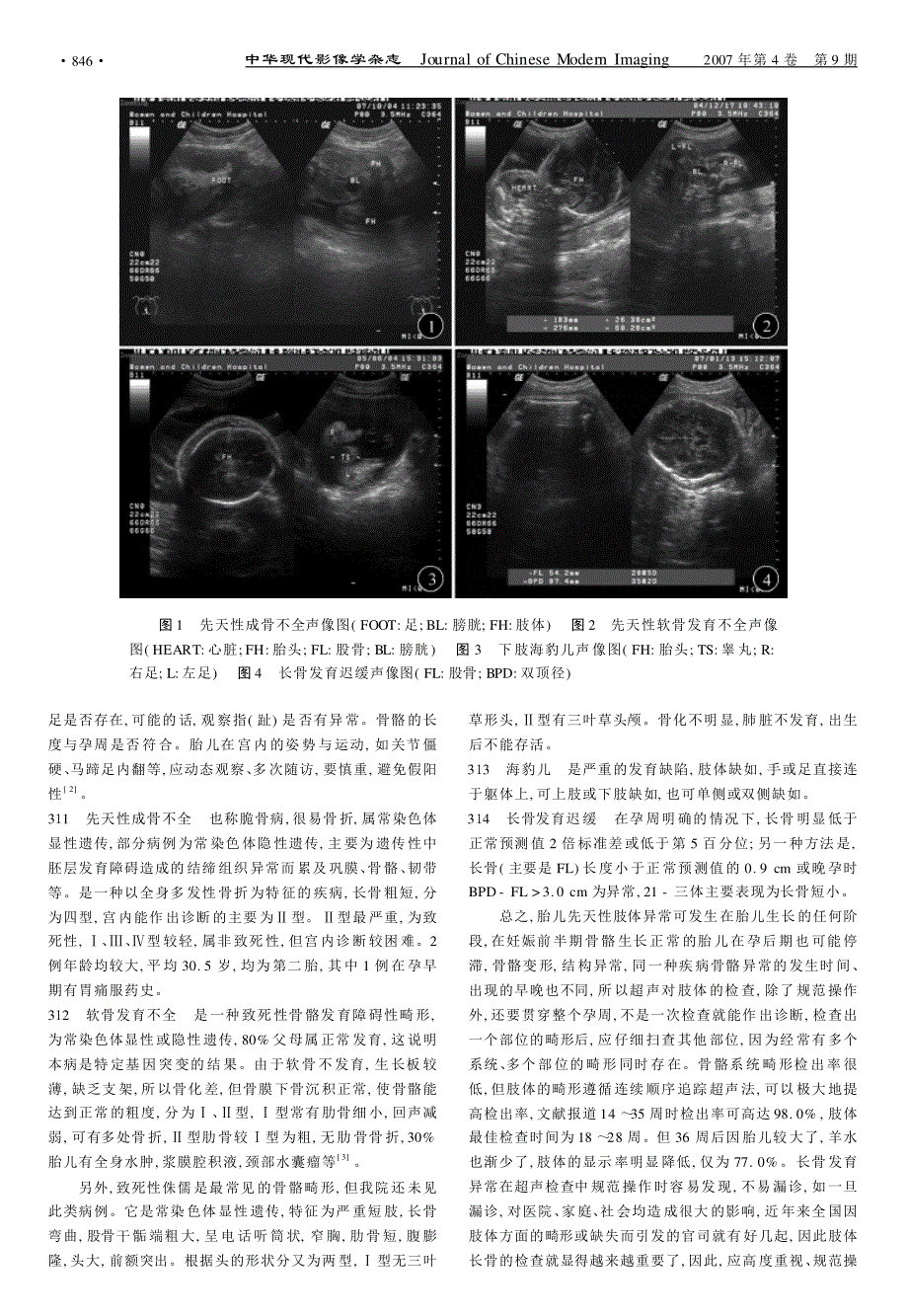 超声对胎儿肢体畸形的诊断体会_第2页