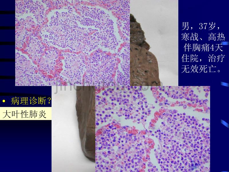 08 呼吸系统疾病(2)黎2_第5页