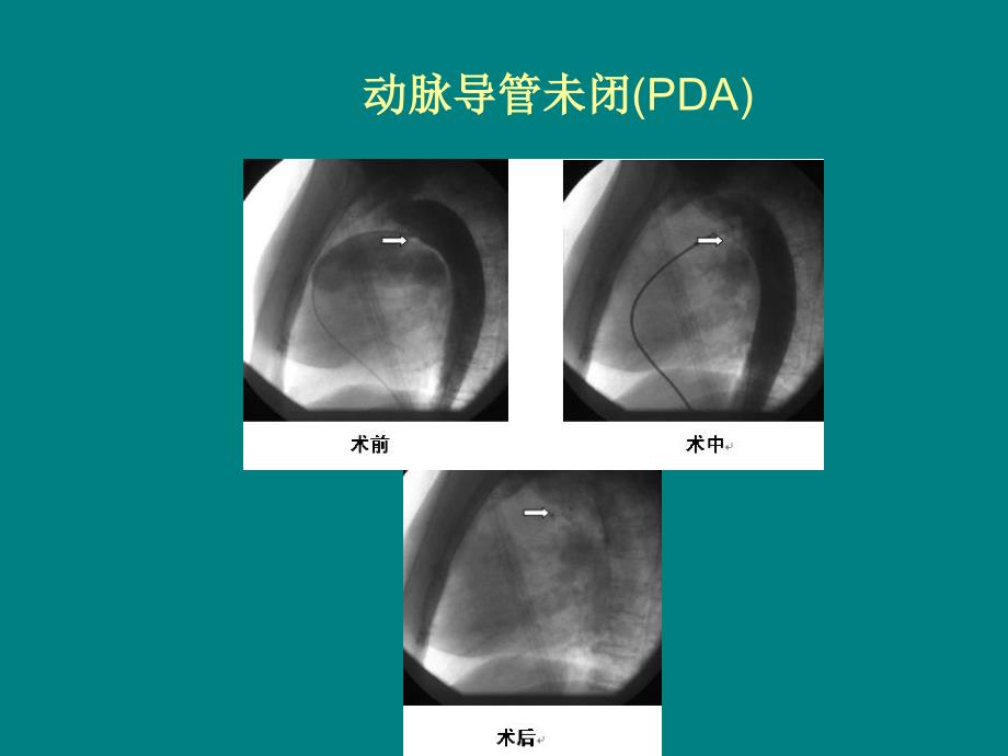 先心病介入诊断和治疗_第4页