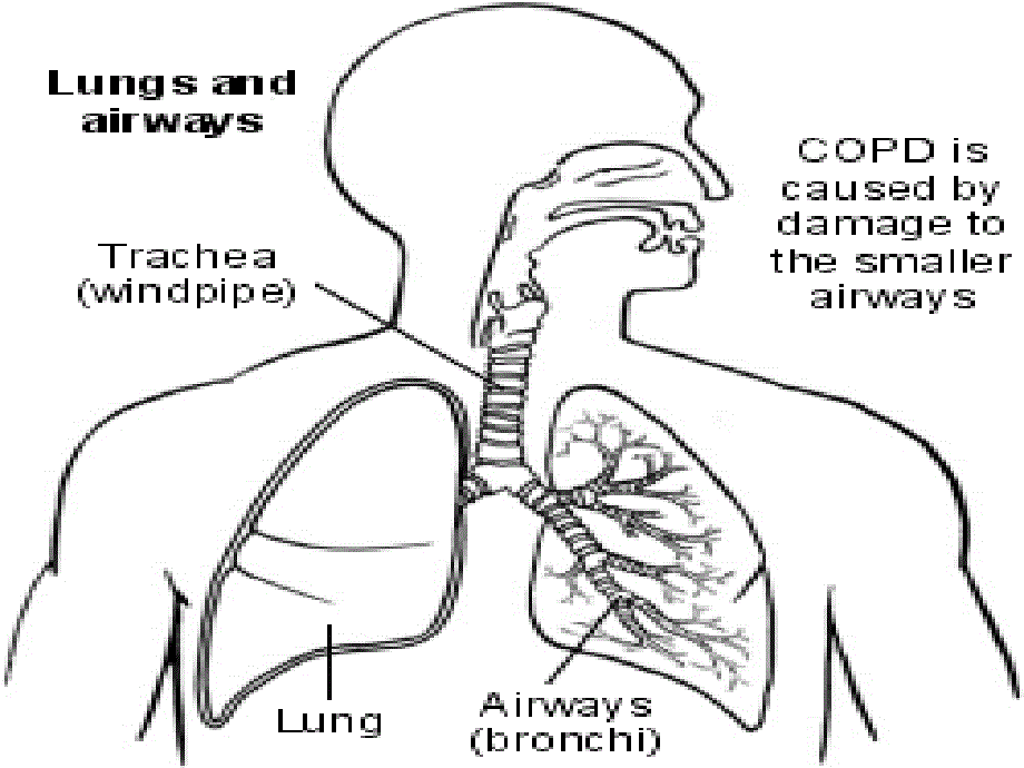 COPD、慢性支气管炎_第4页