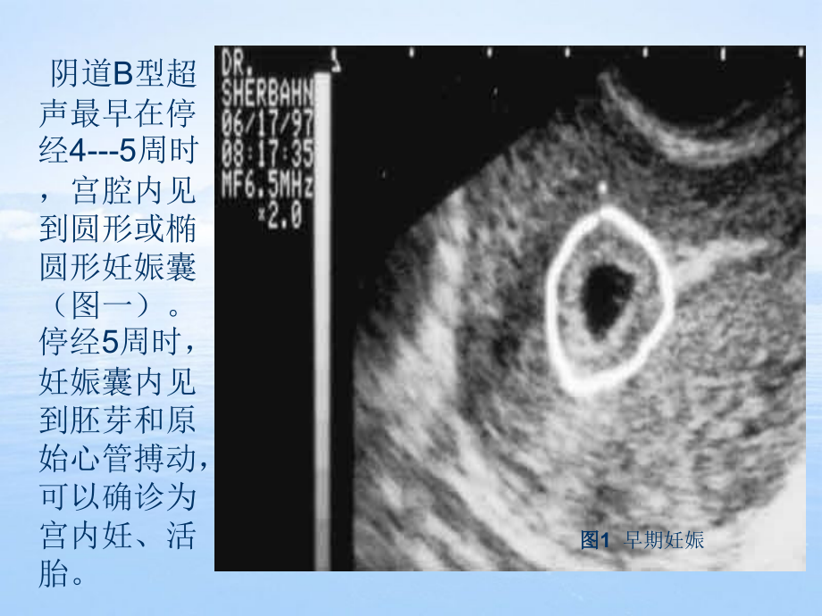 妊娠滋养细胞疾病_第2页