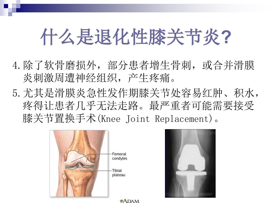退化性膝关节炎的康复治疗_第4页