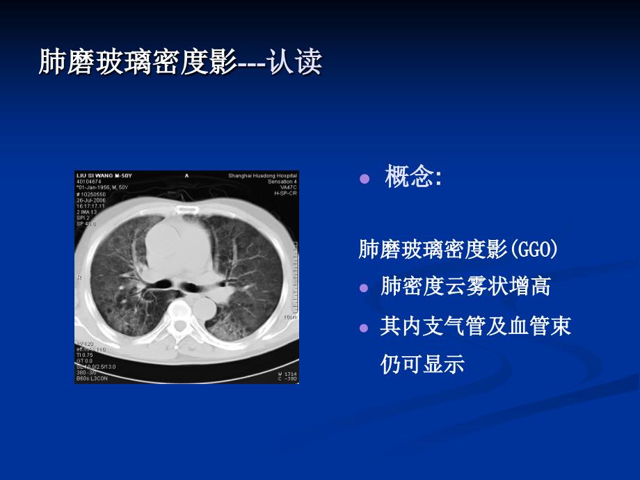 肺磨玻璃密度影认读与鉴赏_第3页