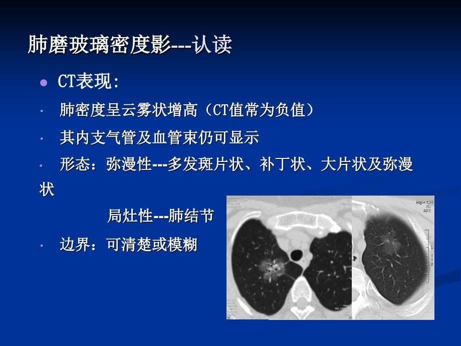 肺磨玻璃密度影认读与鉴赏_第5页