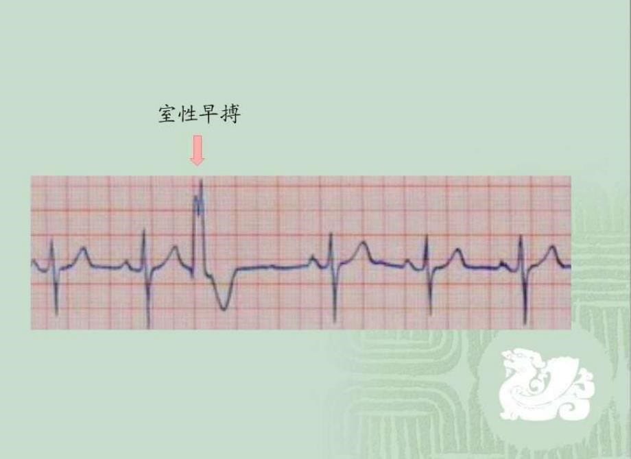 强心苷对兔心的毒性作用和利多卡因的抗心律失常作用_第5页