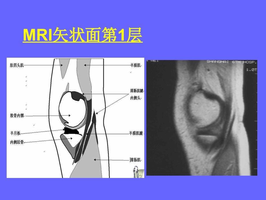 膝关节MRI与解剖_第5页