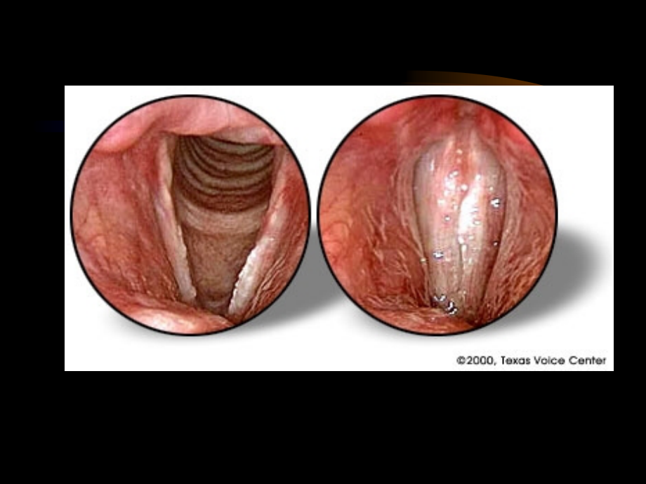 喉癌和喉咽癌（Carcinoma of Larynx）_第3页