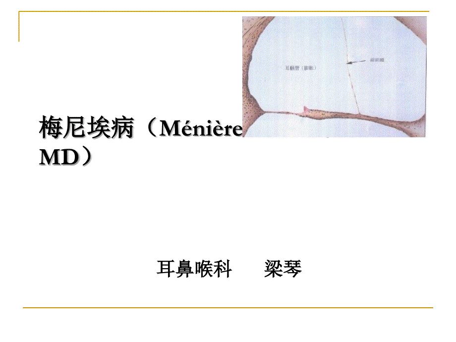 梅尼埃病Ménière disease，MD）梁琴－耳鼻喉科