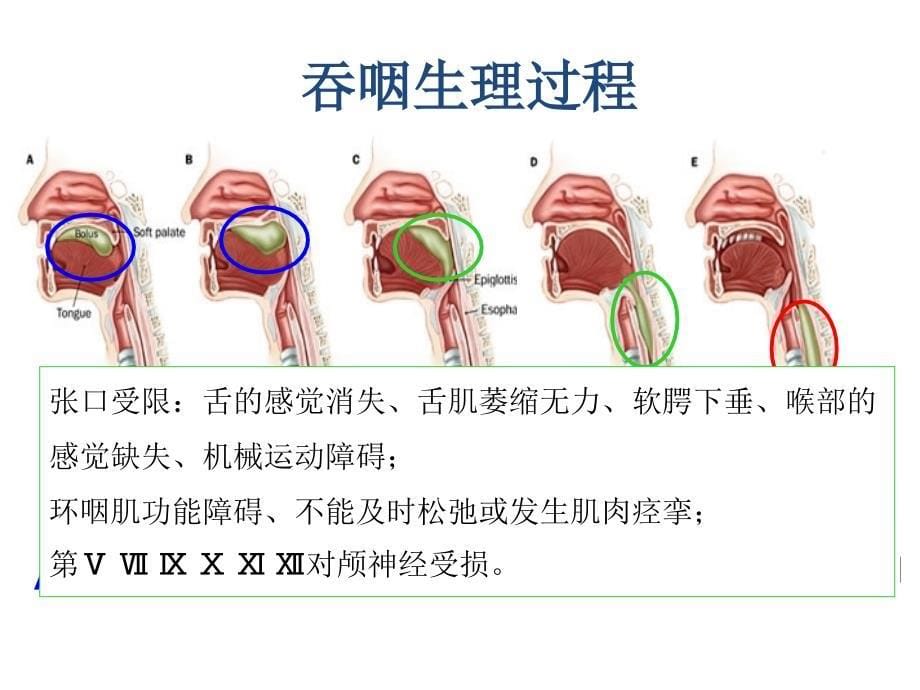 老年患者误吸指标建立与护理实践_第5页