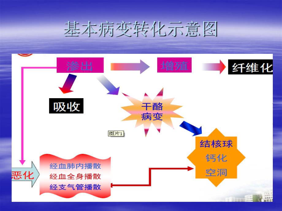 肺结核影像诊断_第4页