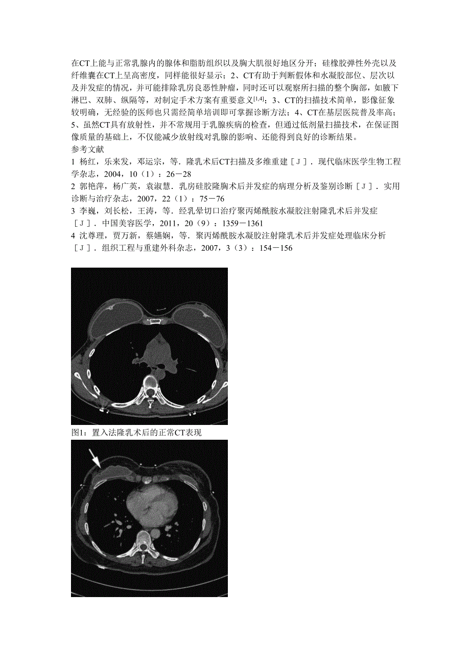 CT在隆胸术后并发症诊断中的应用_第3页