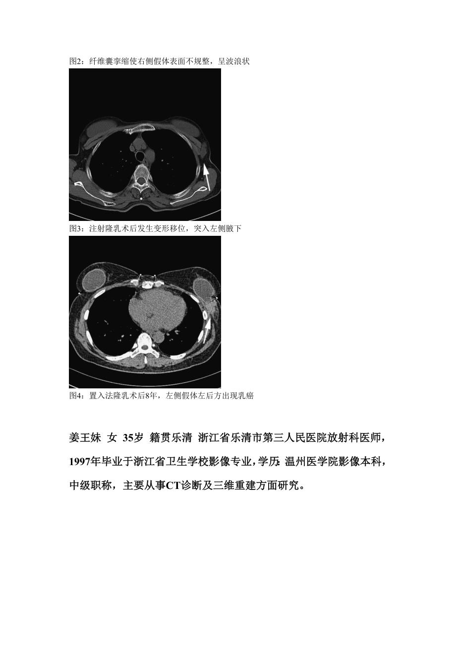 CT在隆胸术后并发症诊断中的应用_第4页