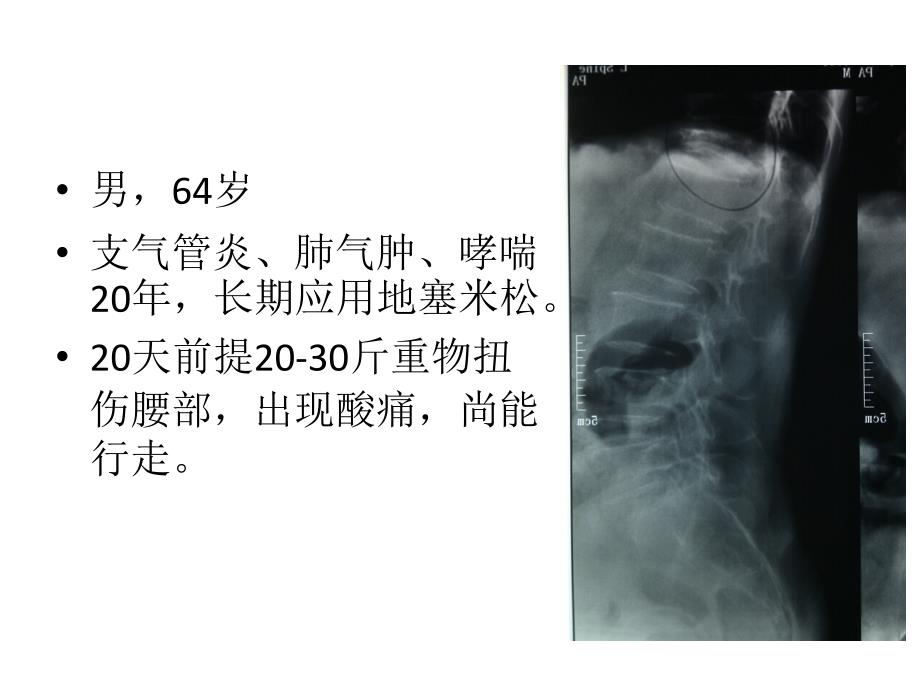 kummell 病_第2页