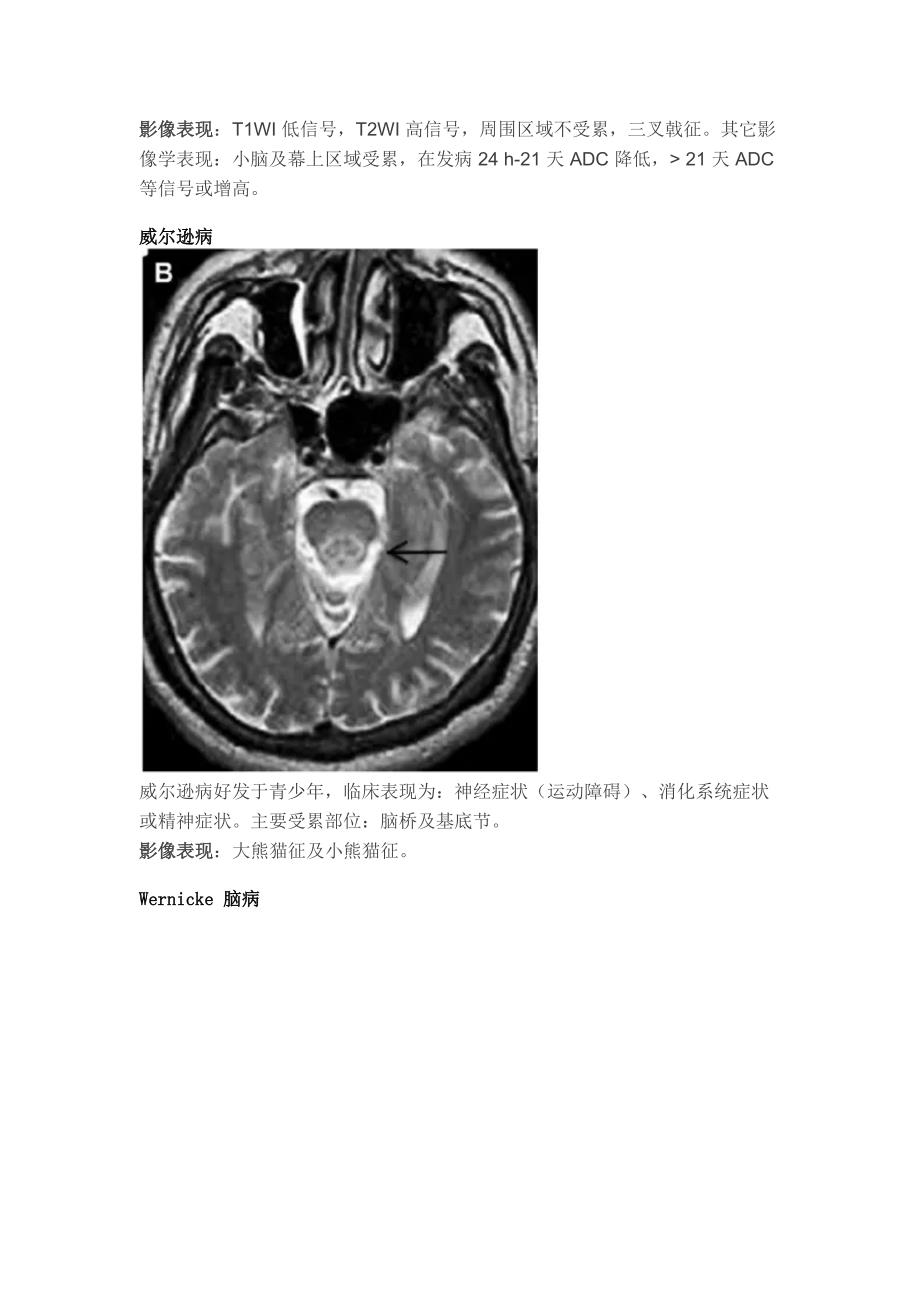 张图理清脑干病变(代谢炎症篇)_第2页