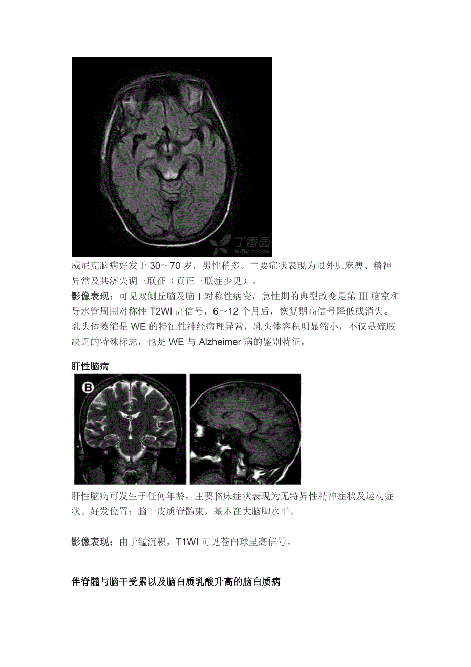 张图理清脑干病变(代谢炎症篇)_第3页