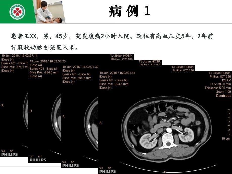 肠系膜上动脉夹层介入治疗术后肠梗阻_第5页