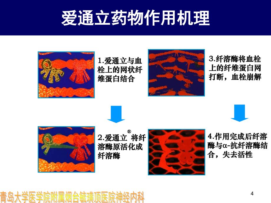 急性脑梗塞溶栓--梁志刚_第4页