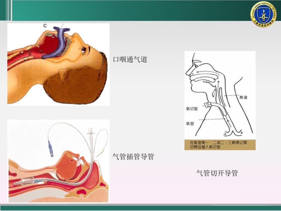 人工气道吸引技术_第4页