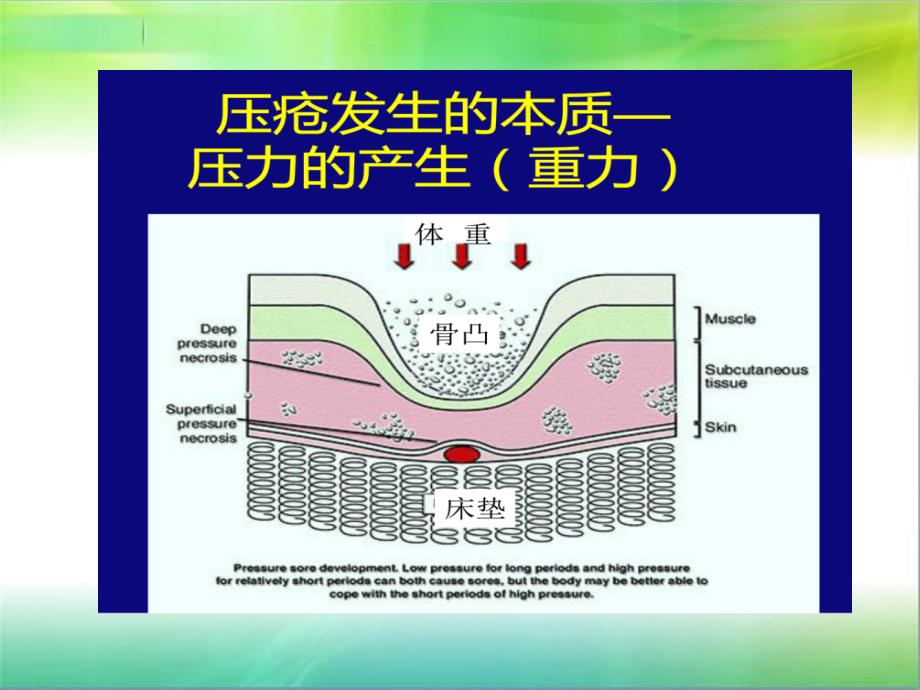 压疮的培训课件_第4页