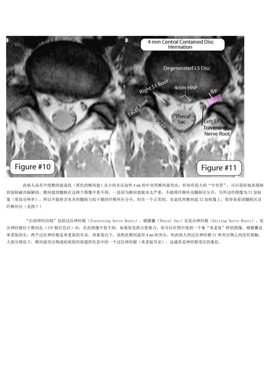 怎样看椎间盘CT_MRI_片_第3页