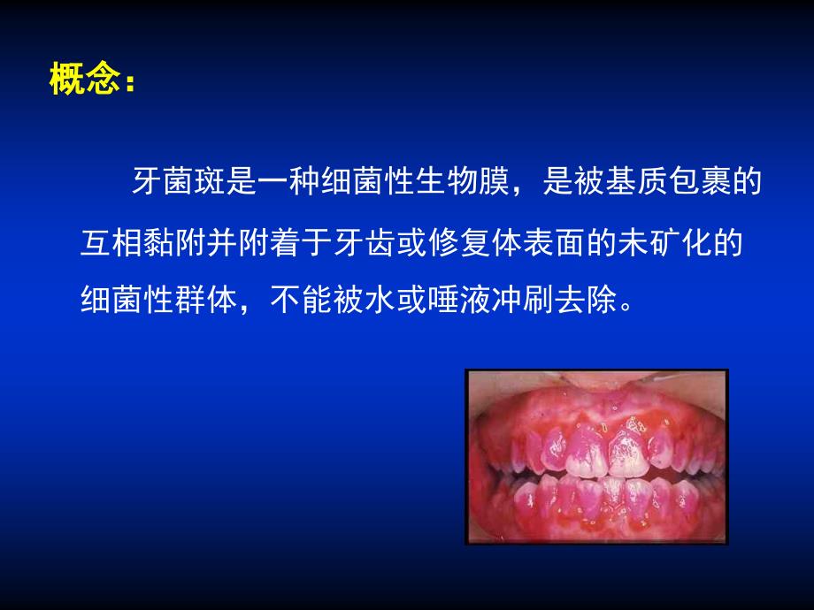 牙菌斑生物膜_第4页
