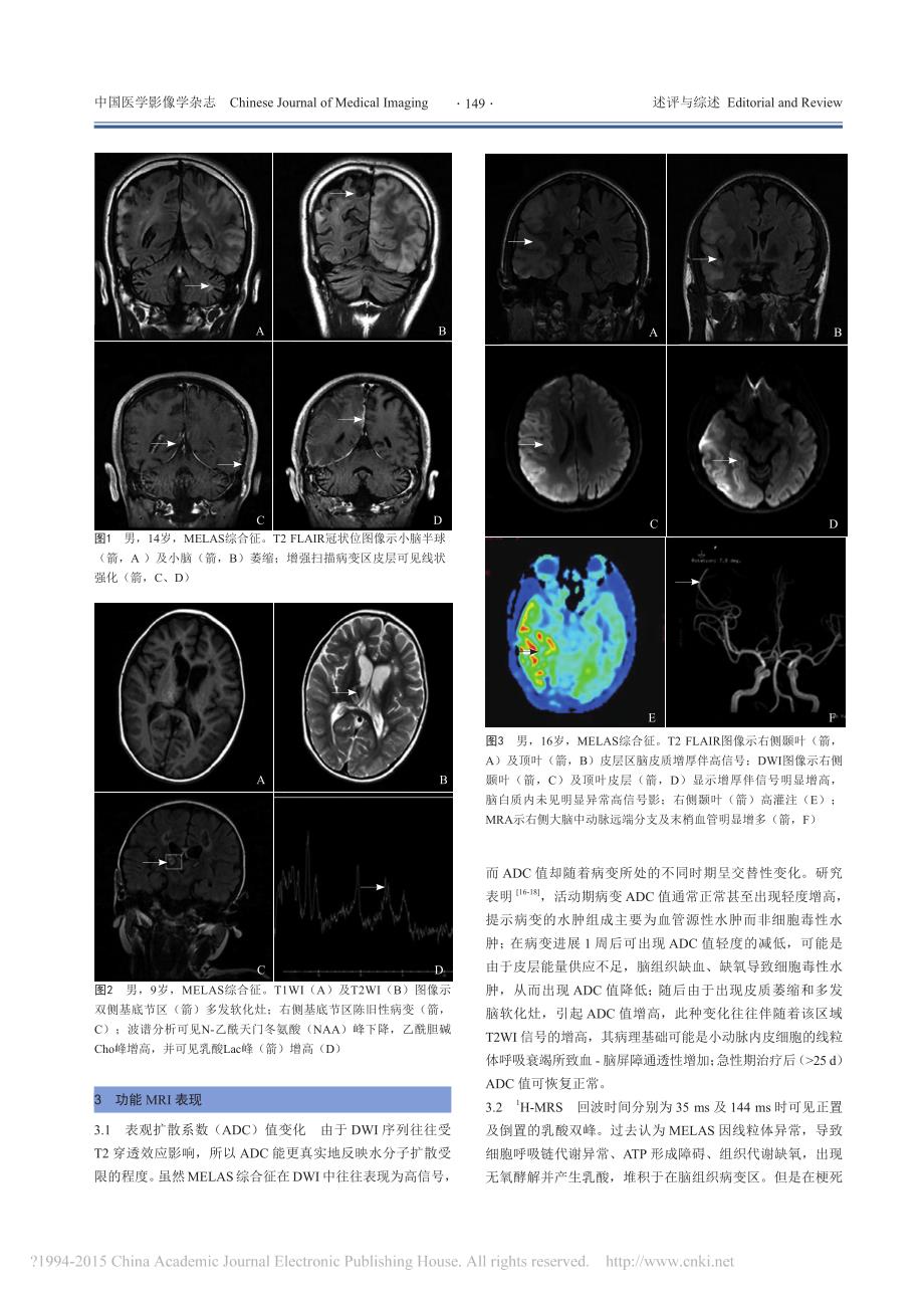 线粒体脑肌病伴高乳酸血症和脑卒中_省略_发作综合征的MRI表现与研究进展_许洋_第2页