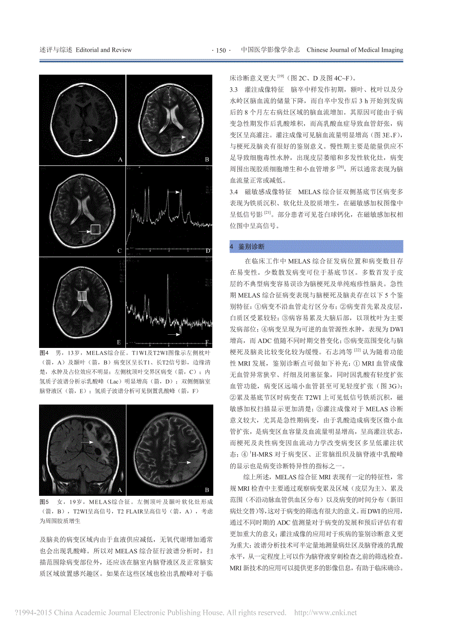 线粒体脑肌病伴高乳酸血症和脑卒中_省略_发作综合征的MRI表现与研究进展_许洋_第3页