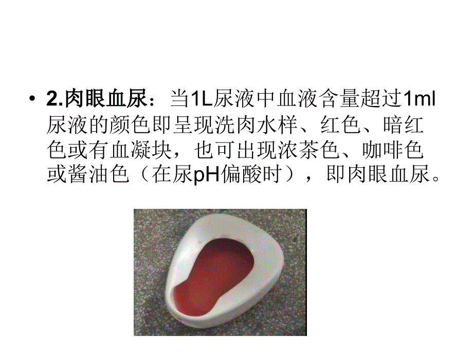 浅谈血尿的临床意义_第3页