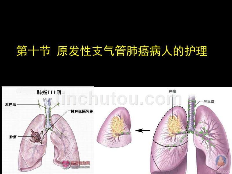 【2017年整理】第十节  原发性支气管肺癌病人的护理_第1页